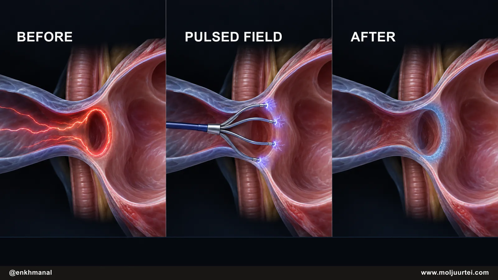Conceptual before, treatment, and after view of pulmonary-vein isolation by pulsed-field ablation